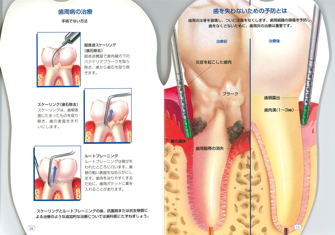 歯周病をていねいにケア