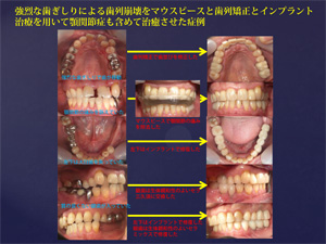 顎関節症の治療方法