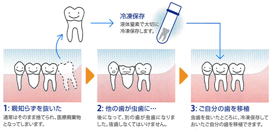 歯のリサイクル