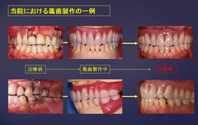 入れ歯製作に自信を持つ理由