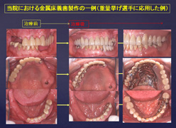 入れ歯製作に自信を持つ理由