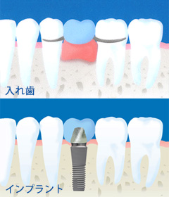 入れ歯とインプラントに関する一般的な誤解