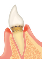 歯周病の進行
