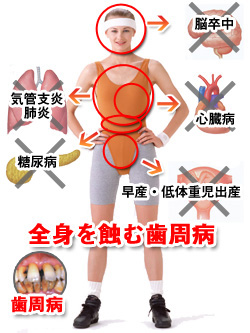 歯周病と全身疾患の関係