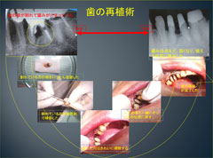 歯を抜かない治療
