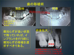 歯を抜かない治療