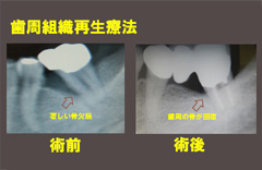 歯を抜かない治療
